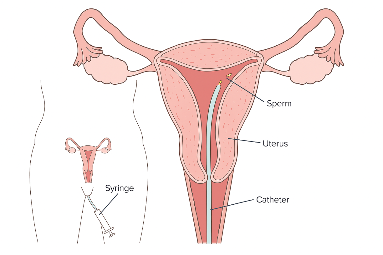 intrauterine insemination IUI
